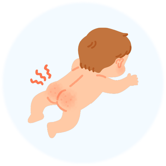 赤ちゃんのおむつかぶれ